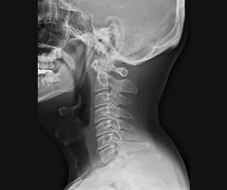 頸椎の画像