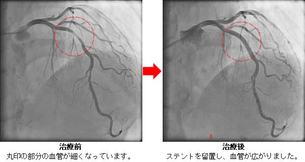 経皮的冠動脈形成術の画像